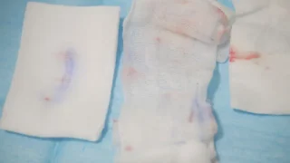 眼瞼下垂症手術のこぼれ話（出血を少なくする工夫）