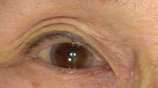 瞼の くぼみ、サンケンアイ（sunken eyelid) は 眼瞼下垂手術で改善できます。