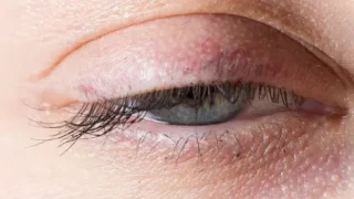 眼瞼下垂の症例｜フラミンゴ眼瞼・美容クリニック