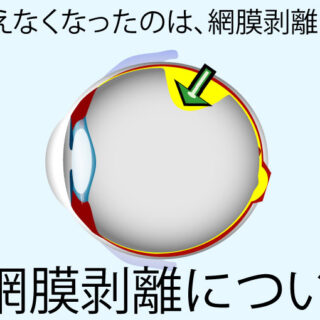 突然見えなくなったのは、網膜剥離なのかもしれません