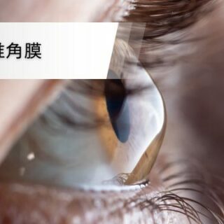 円錐角膜 - 浜松市の高田眼科