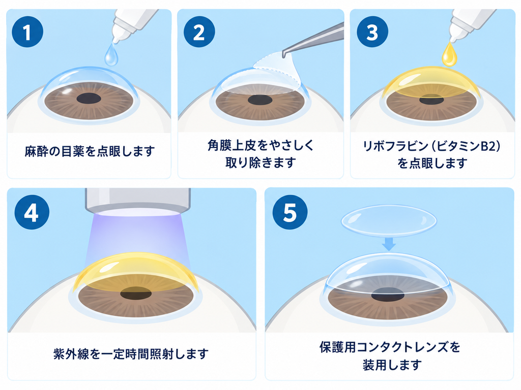 円錐角膜に対する角膜クロスリンキング治療の手順