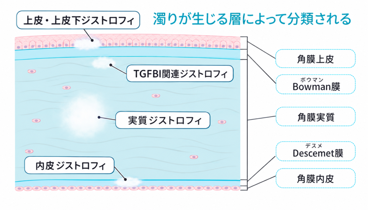 角膜ジストロフィとは？症状・原因・検査・治療を眼科医が解説