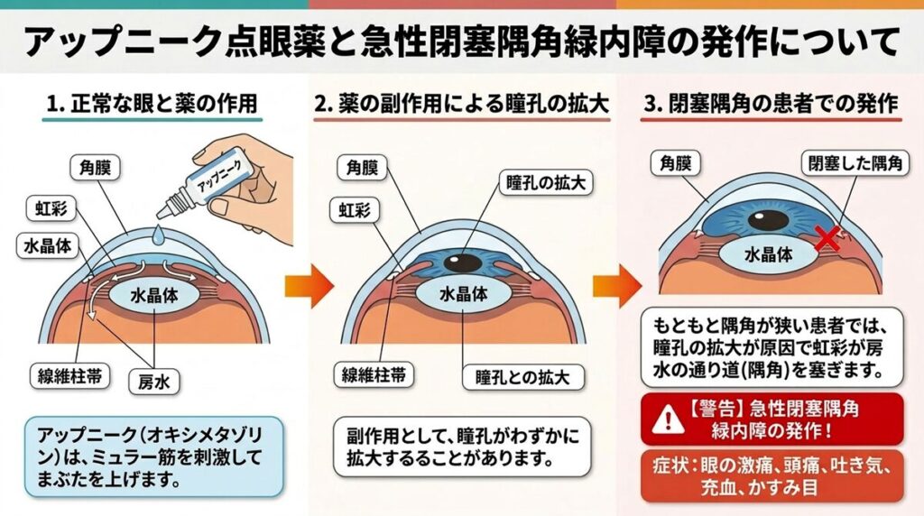 アップニークミニ点眼液による急性緑内障発作の仕組みについてのイラスト