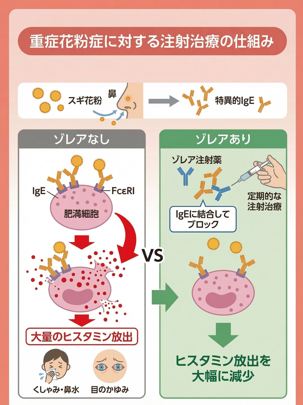 重症花粉症に対するゾレアの作用機序とヒスタミン放出の流れを示した画像