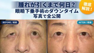 眼瞼下垂手術のダウンタイムを時系列写真で比較|保険診療・自由診療の切開手術・眉下切開の経過について解説