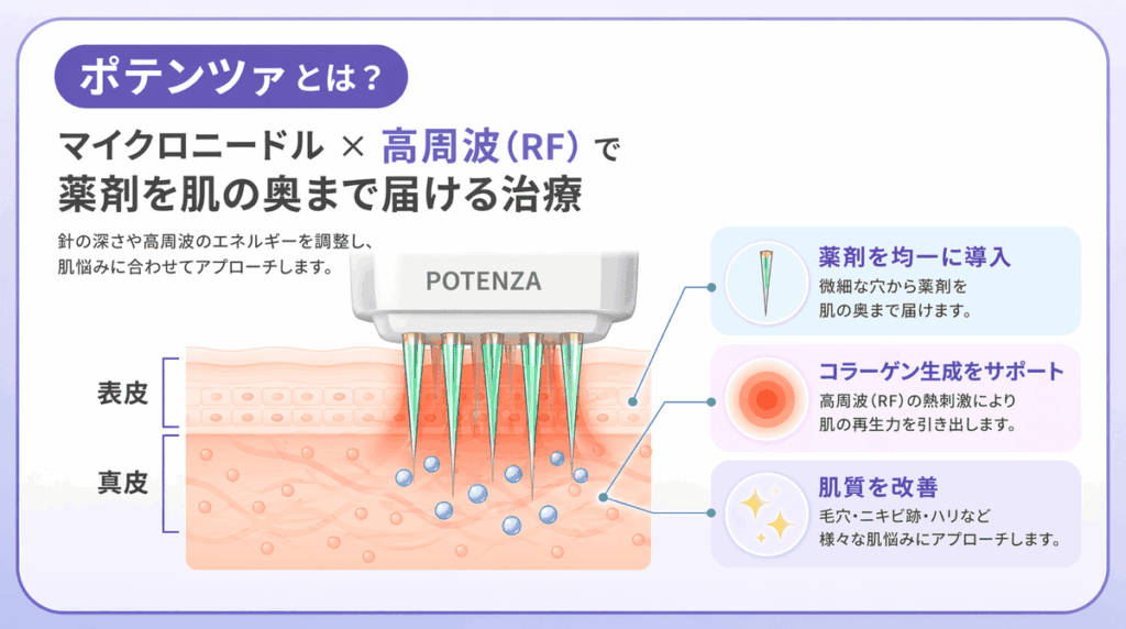 ポテンツァは高周波とマイクロニードルで薬剤を均一に導入する