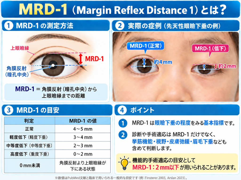 MRD-1の測定方法を示す図。角膜反射から上まぶたの縁までの距離を、先天性眼瞼下垂の症例写真とともに比較