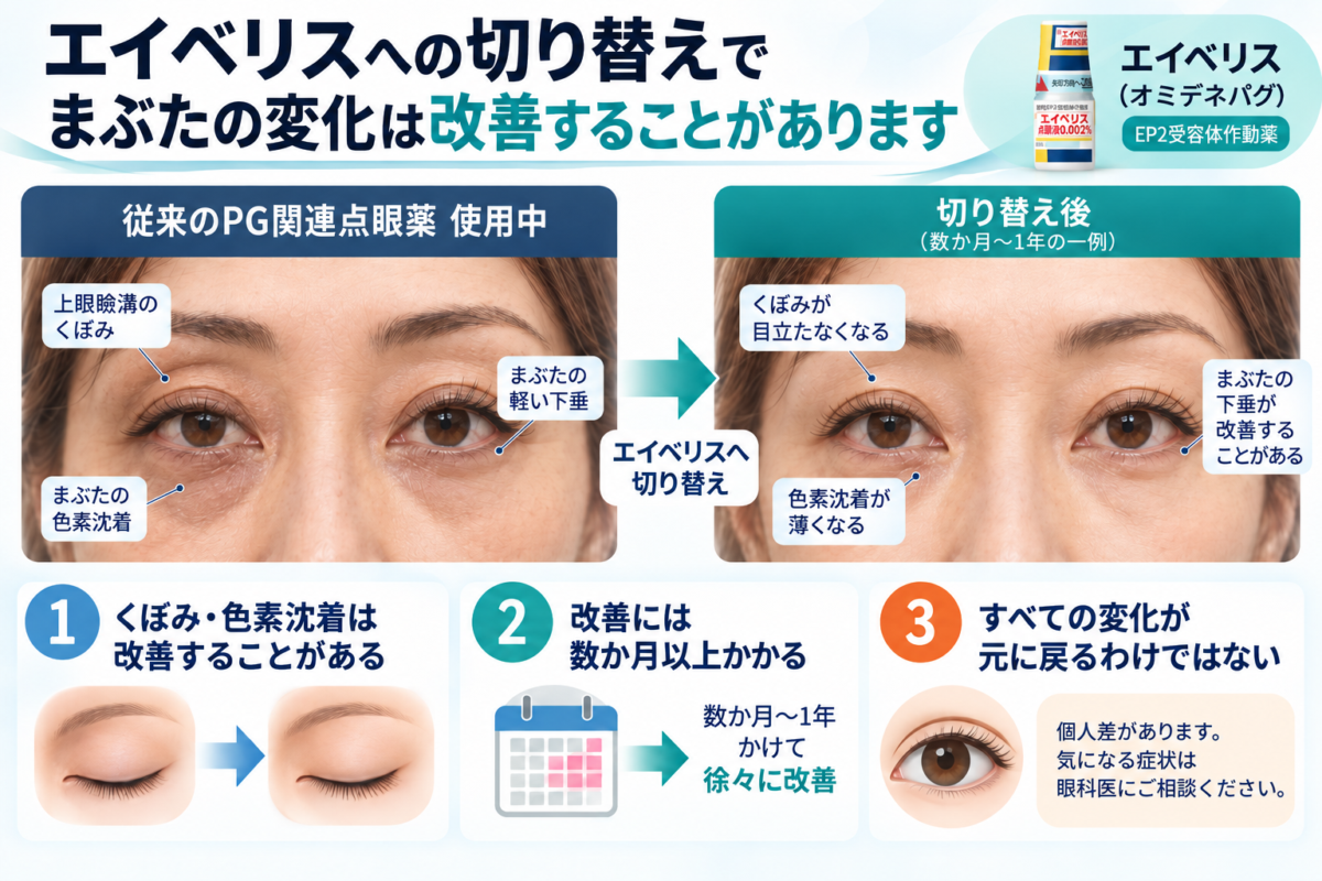 PG関連緑内障点眼薬からエイベリスへの切り替え後に、上眼瞼のくぼみや色素沈着などのPAPが改善する場合を説明した図