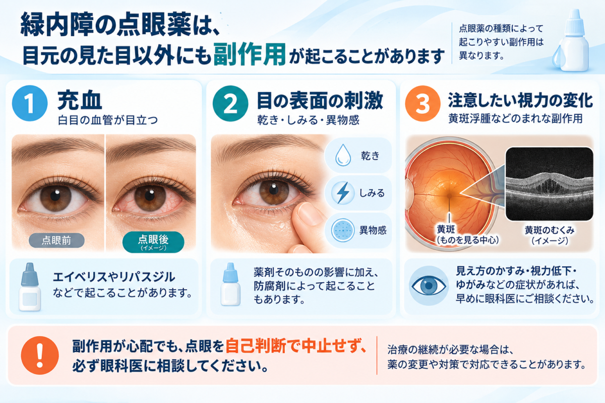 緑内障点眼薬のPAP以外の副作用：結膜充血、眼表面の刺激と乾燥、黄斑浮腫などの視力への影響