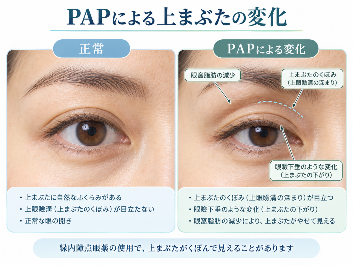 緑内障の目薬によるPAP（プロスタグランジン関連眼窩周囲症）と眼瞼下垂・上まぶたのくぼみを解説するイラスト