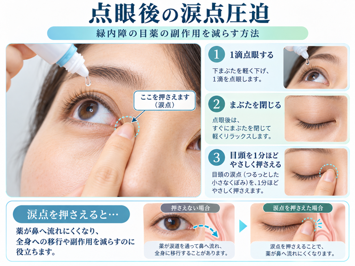 緑内障点眼薬の副作用を減らす涙点閉鎖の方法｜点眼後に目を閉じて目頭を軽く押さえる手順を示したイラスト