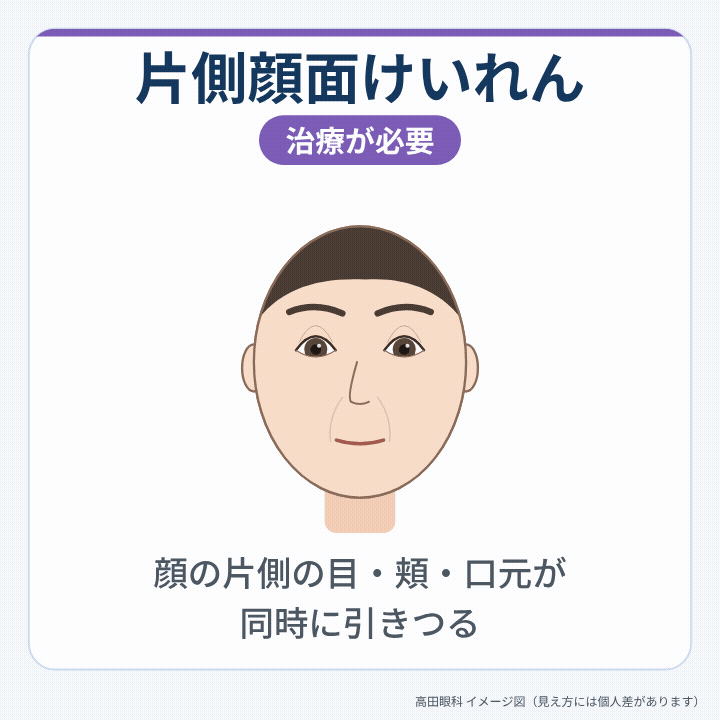 片側顔面けいれんで顔の片側の目・頬・口元が同時に引きつる様子を示したアニメーション
