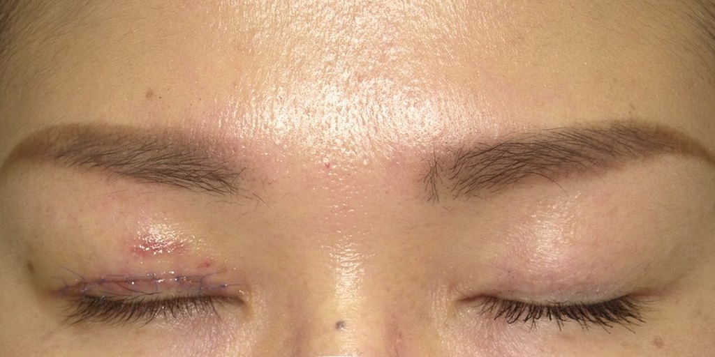 ホルネル症候群の眼瞼下垂手術から1週間後の閉眼写真