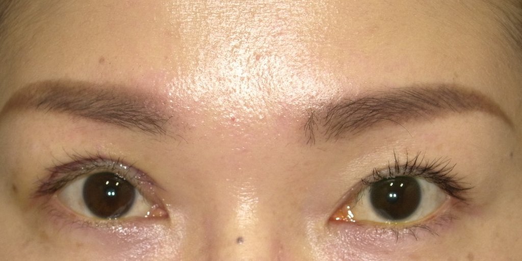 ホルネル症候群の眼瞼下垂手術から1週間後の開眼写真