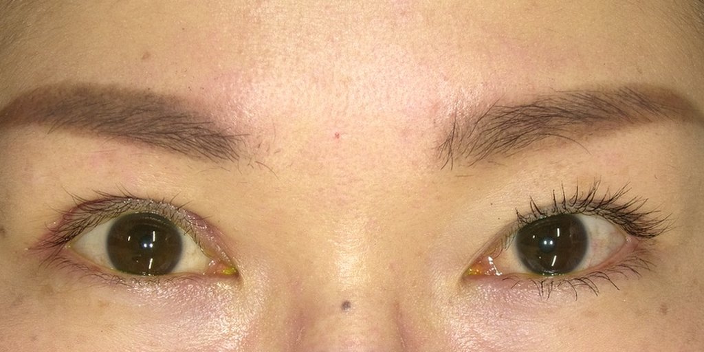 眼瞼挙筋前転法から2週間後、抜糸時の写真