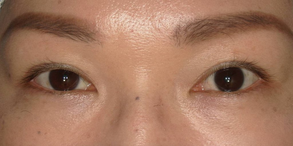 ホルネル症候群による右眼の眼瞼下垂 手術直前の正面写真