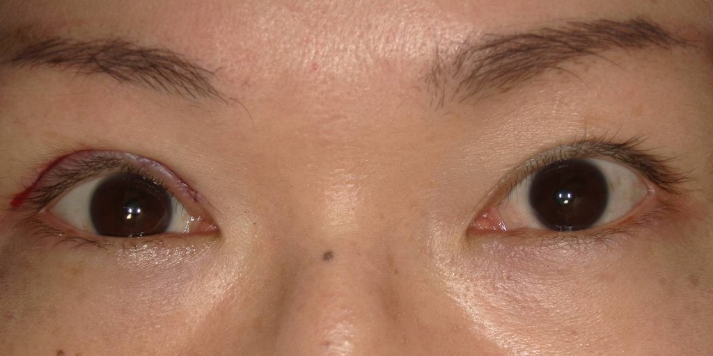 眼瞼挙筋前転法の手術中、皮膚を縫う直前に左右の高さとまぶたのカーブを確認している写真
