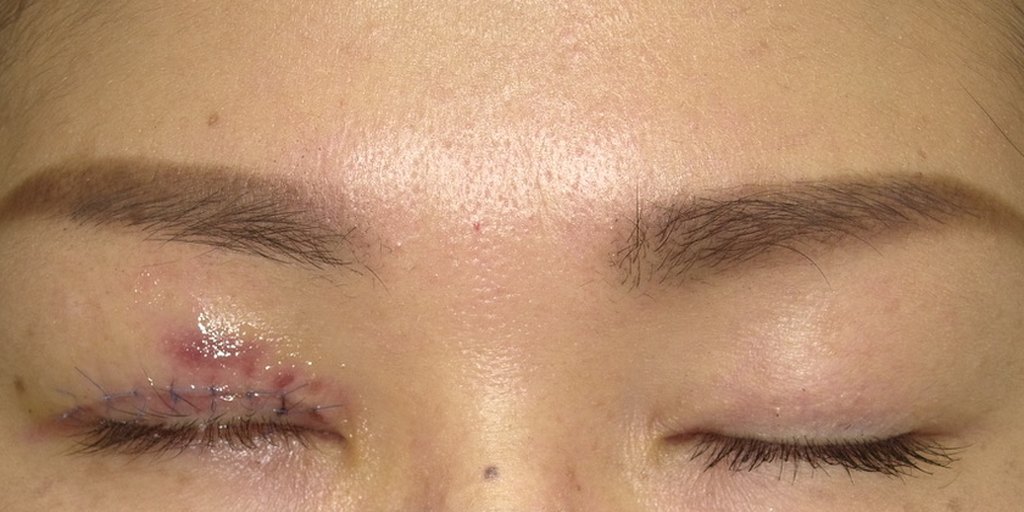 ホルネル症候群の眼瞼下垂手術の翌日の閉眼写真 右上まぶたの縫合と内出血
