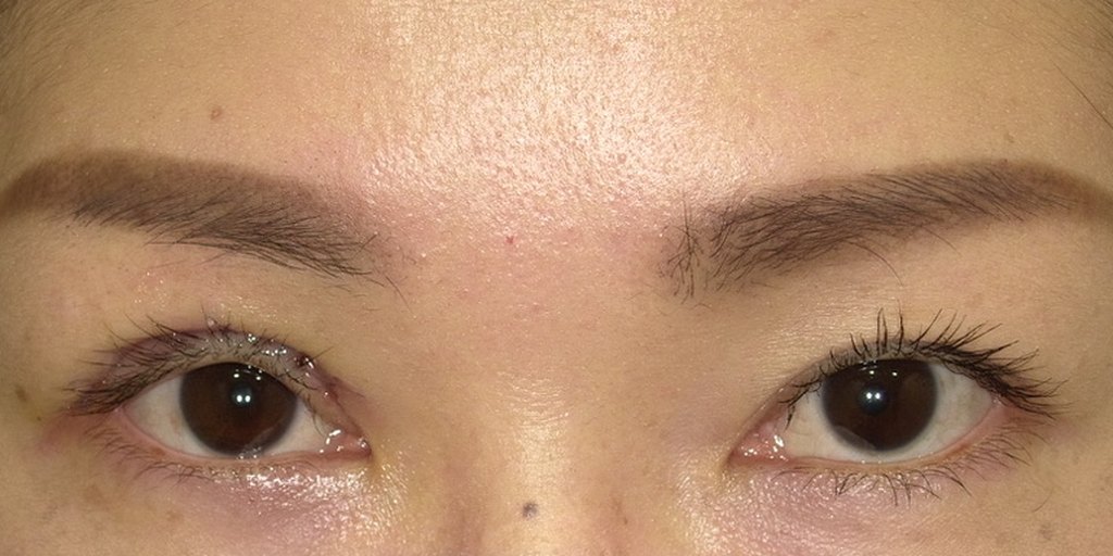 ホルネル症候群の眼瞼下垂手術の翌日の開眼写真