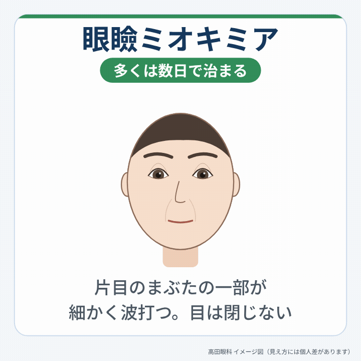 まぶたを閉じる筋肉（眼輪筋）と、眼瞼ミオキミアでピクピクしやすい下まぶたの位置を示した図