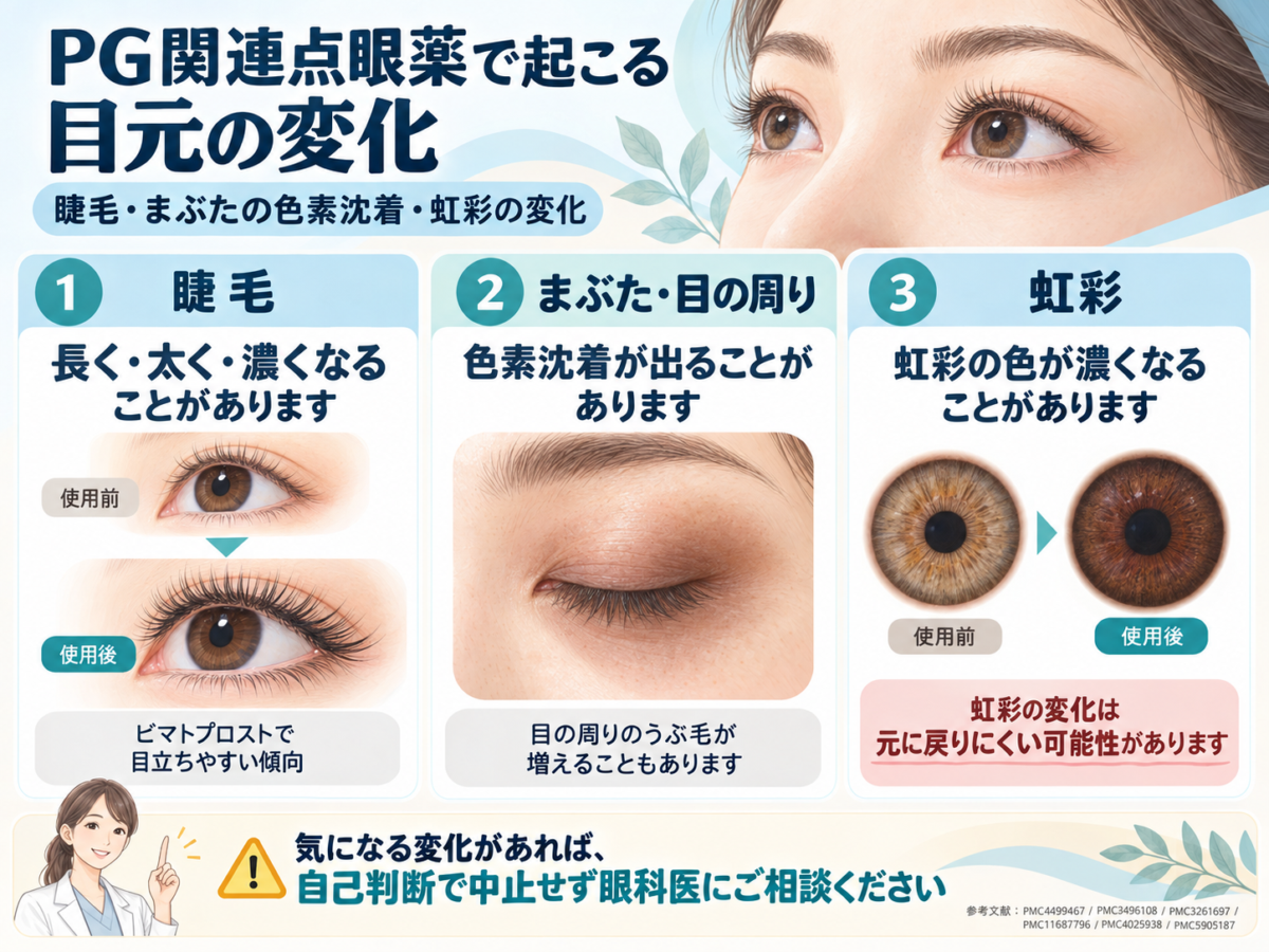 プロスタグランジン関連緑内障点眼薬によるまつ毛の伸長、まぶたの色素沈着、虹彩色素沈着の3つの外見上の副作用